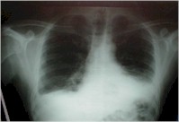 opacidad de tipo pleural