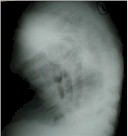 tabicamiento posterior inferior izquierdo del derrame pleural