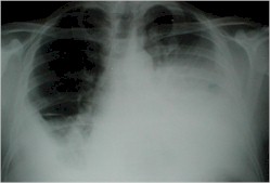 derrame_pleural_rx