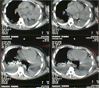 derrame_pleural_tac