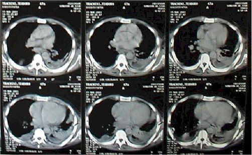 derrame_pleural_tac