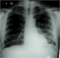 empiema_pleural_radiografia_torax