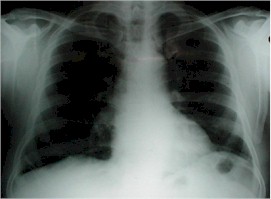 empiema_pleural_radiografia_torax